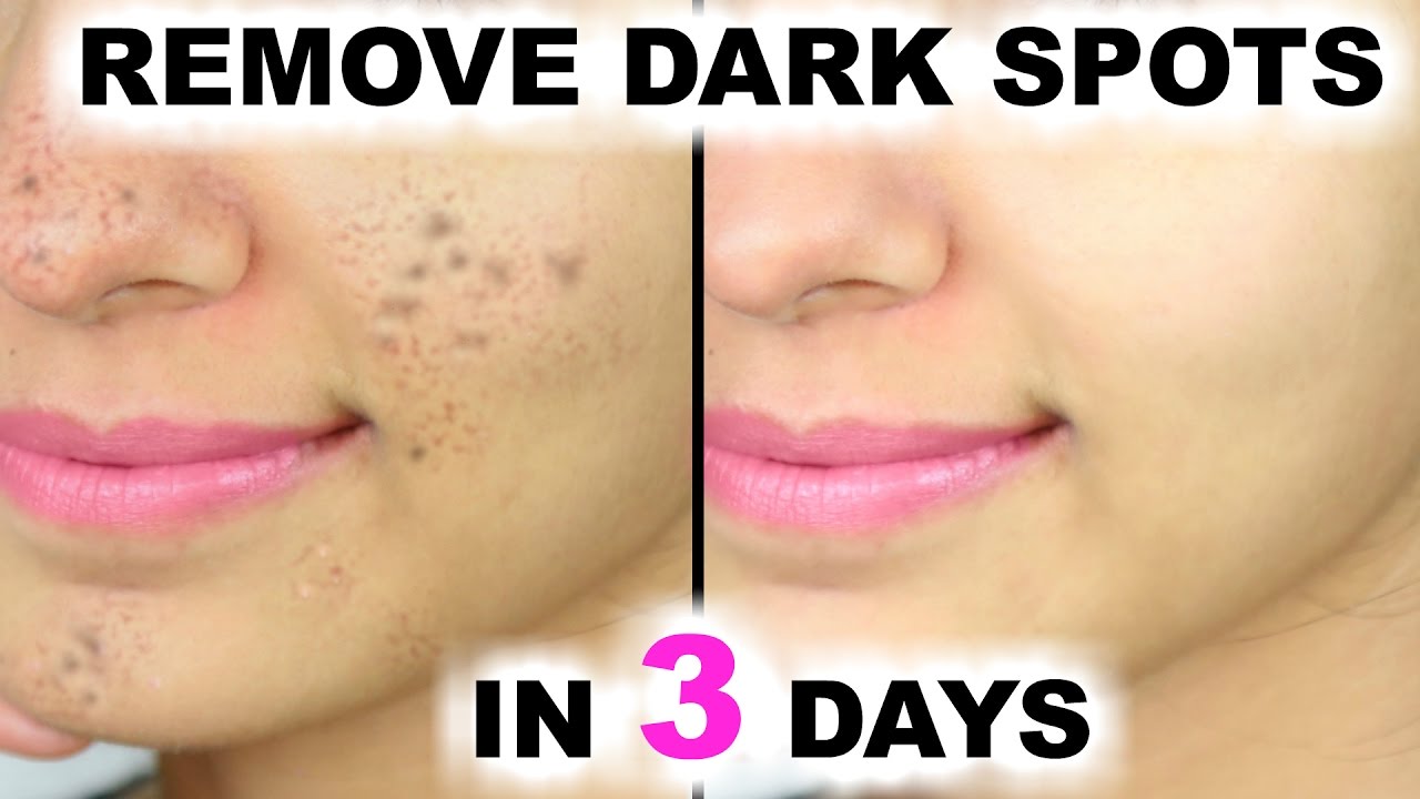 How to remove facial marks - Adult archive Quality porn Erotic asian oily dance video